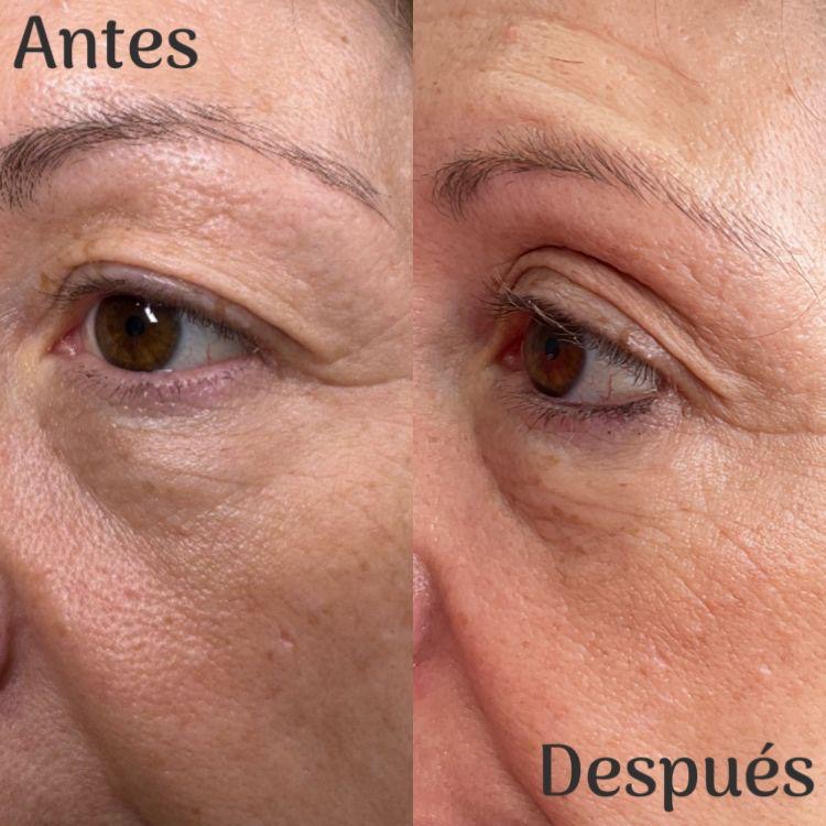 Timeless con neuromoduladores
