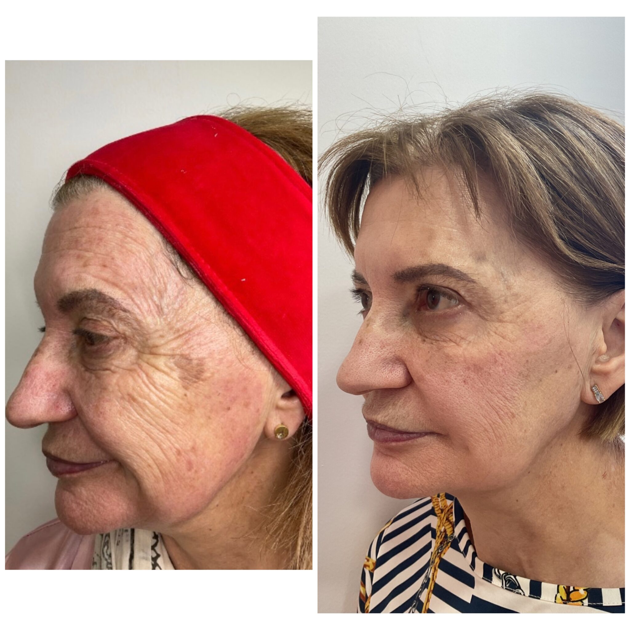 Skin revival