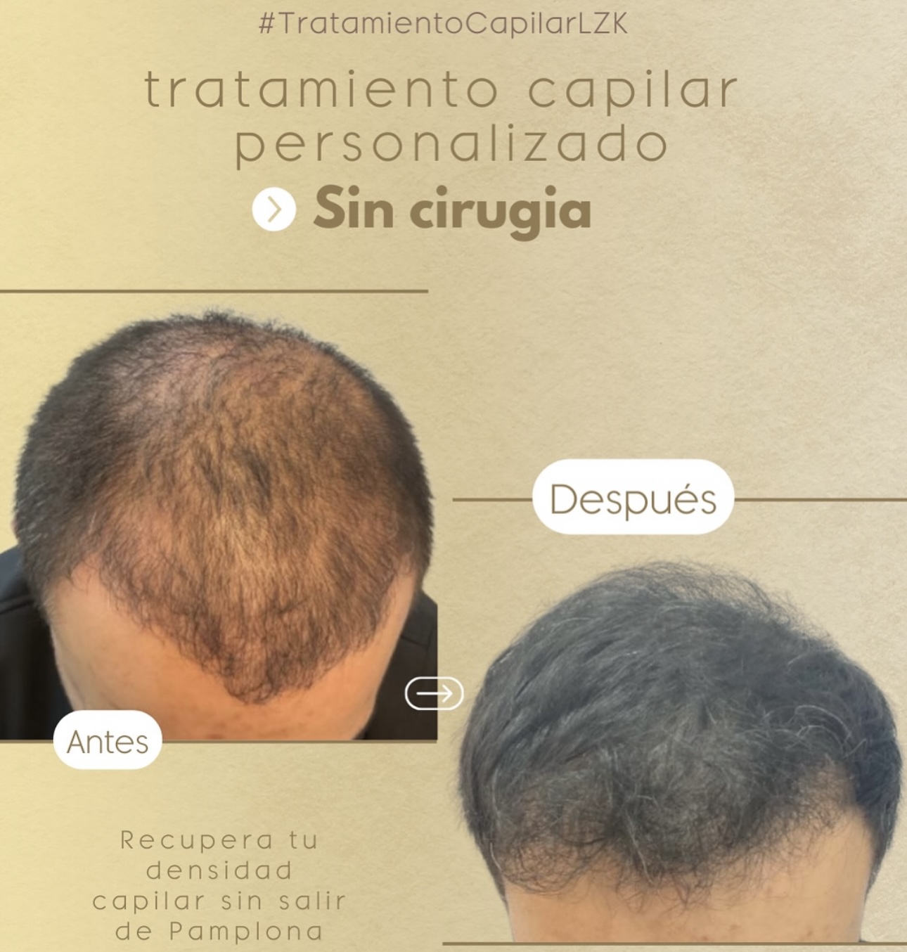 Injerto capilar