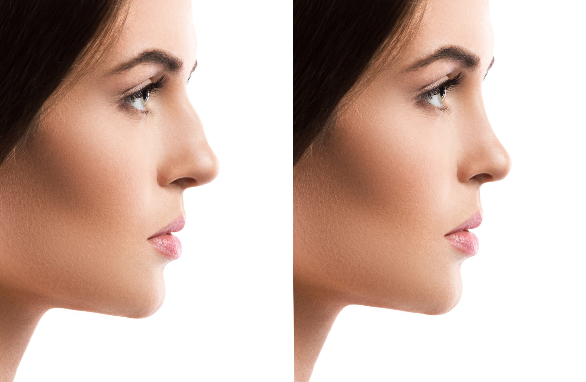 Rinoplastia
